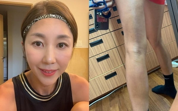 `윤종신♥` 전미라, 햄스트링파열 부상 "처음 느낀 고통"