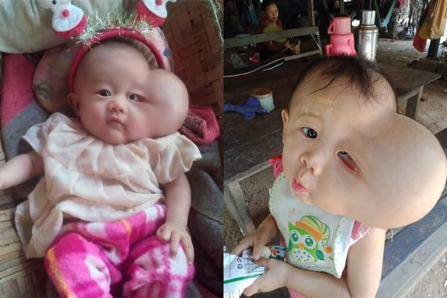 미얀마 '하트 머리' 아기 2kg 혹 떼어준 한국 의사