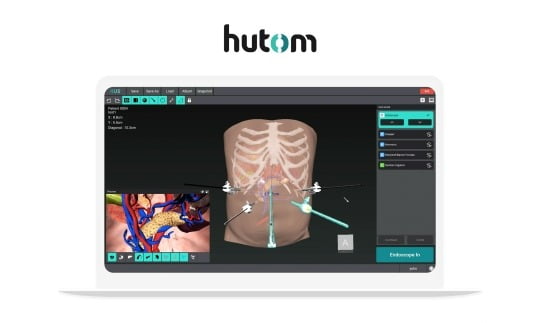 복강경 수술 내비게이션 'RUS' / 사진 제공=휴톰