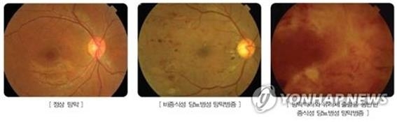 "눈 건강엔 2형 당뇨가 1형 당뇨보다 더 나쁘다"