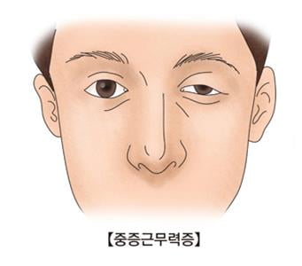 미국 FDA, 중증 근무력증 치료제 최초 승인