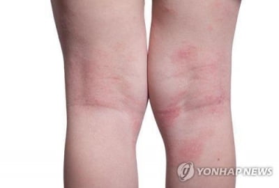 미 FDA, 레오파마 성인 아토피 피부염 치료제 승인