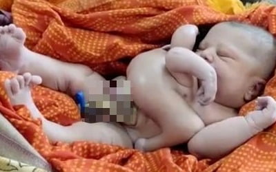 팔·다리 각각 4개인 아기 출산…인도 주민들 "신의 화신" 