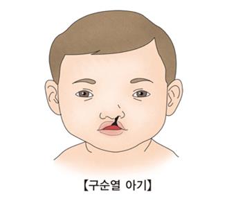 "구순열·구개열, 소득 수준과 관계있다"