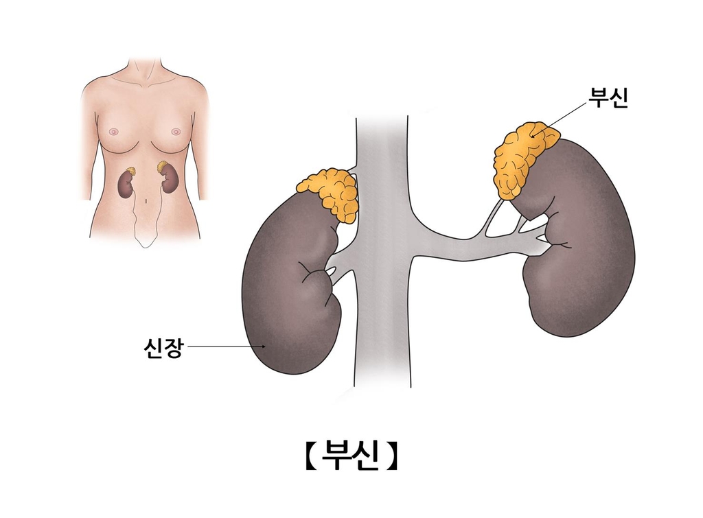 "부신 양성 종양, 당뇨병·고혈압 위험↑"