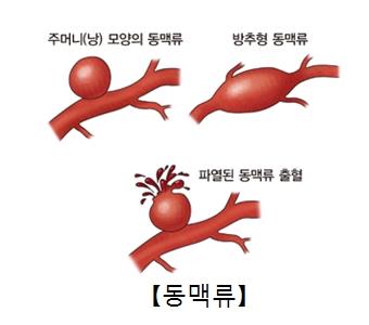 "발기부전 치료제 비아그라, 대동맥류 악화시킬 수도"