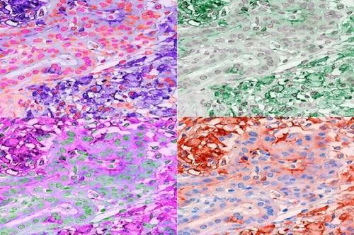 코로나 백신 mRNA 기술로 '심장 섬유증' T세포 치료법 개발