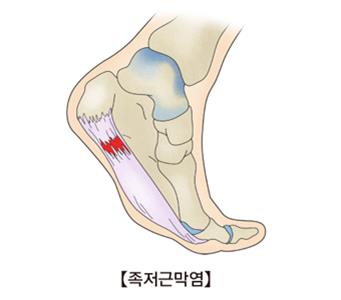 "지방 주입으로 족저(발바닥) 근막염 치료"