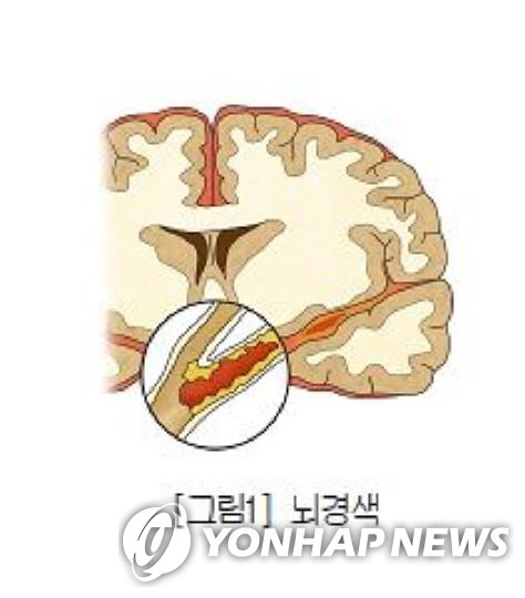 "뇌졸중 횟수-중증도, 치매와 연관"