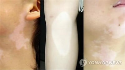 "면역 항암제 효과, 피부 부작용으로 확인"