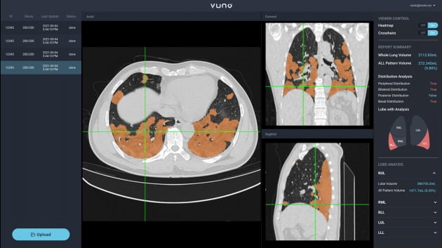 뷰노, 폐 CT 분석 인공지능 솔루션 식약처 인증 획득