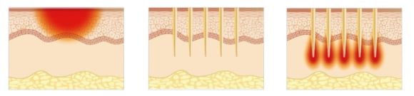 (왼쪽부터) 고주파(RF), 마이크로니들링, RF 마이크로니들링 시스템