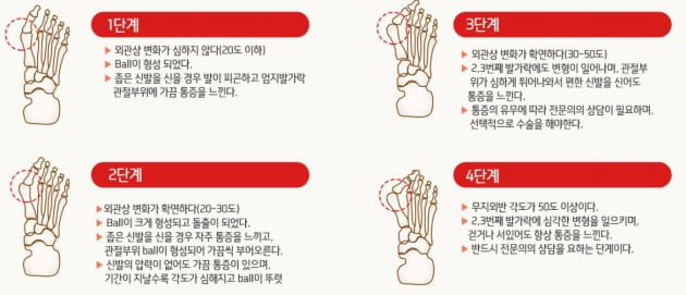 "하이힐 신고 춤 추다 발 모양 변해서" 무지외반증의 심각성 [건강!톡]