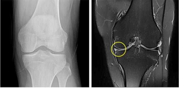 엑스레이 상(왼쪽)으로는 질환이 발견되지 않았지만 MRI 검사 결과 내측 반월상 연골판(노란색 원표시)이 파열된 것을 확인할 수 있다.