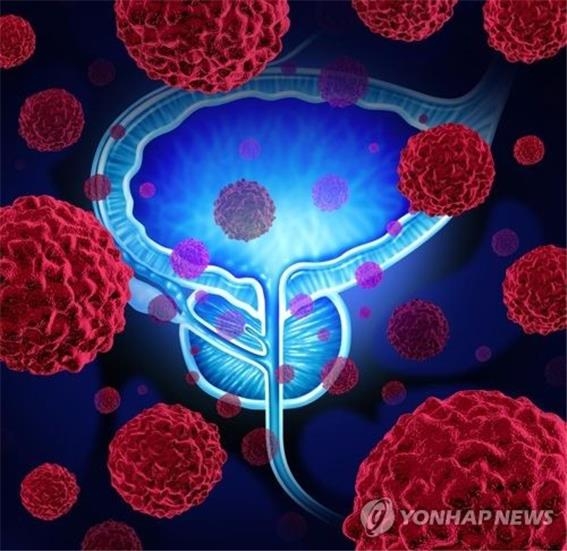 "PSA 검사 줄자 진행성 전립선암 급증"