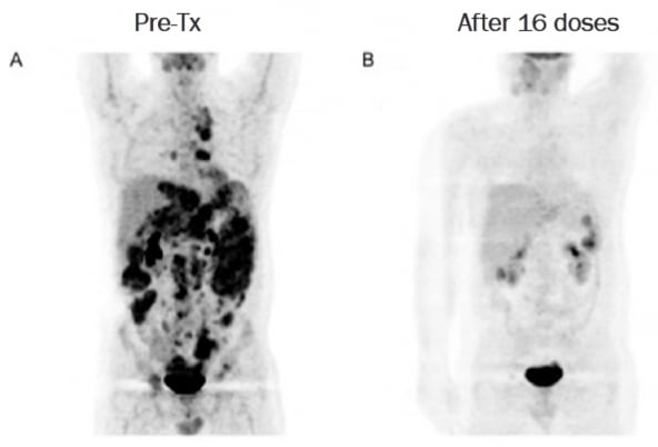 SNK01 병용투여 전(A)과 후(B) 종양 소멸 비교 사진./자료 제공=엔케이맥스