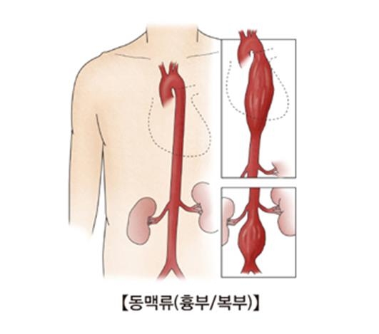 "흉부 대동맥 비대, 심장 건강 적신호"