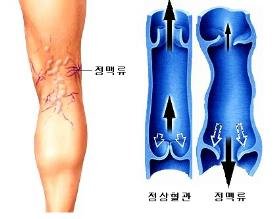 [위클리 건강] '울퉁불퉁 다리혈관' 하지정맥류…치료는 어떻게?