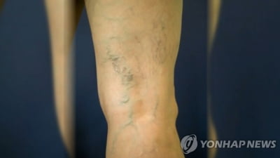 [위클리 건강] '울퉁불퉁 다리혈관' 하지정맥류…치료는 어떻게?