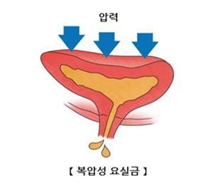 "남성 노인 하부요로 증상, 사망 위험에 영향"