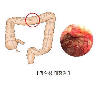 "노년기 항생제, 염증성 장 질환 위험↑"