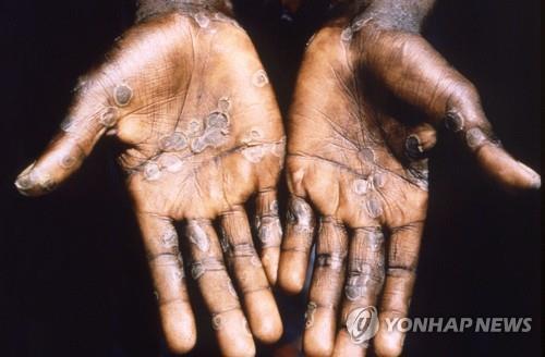 원숭이두창 중동에도 상륙…이스라엘서 첫 감염자 보고