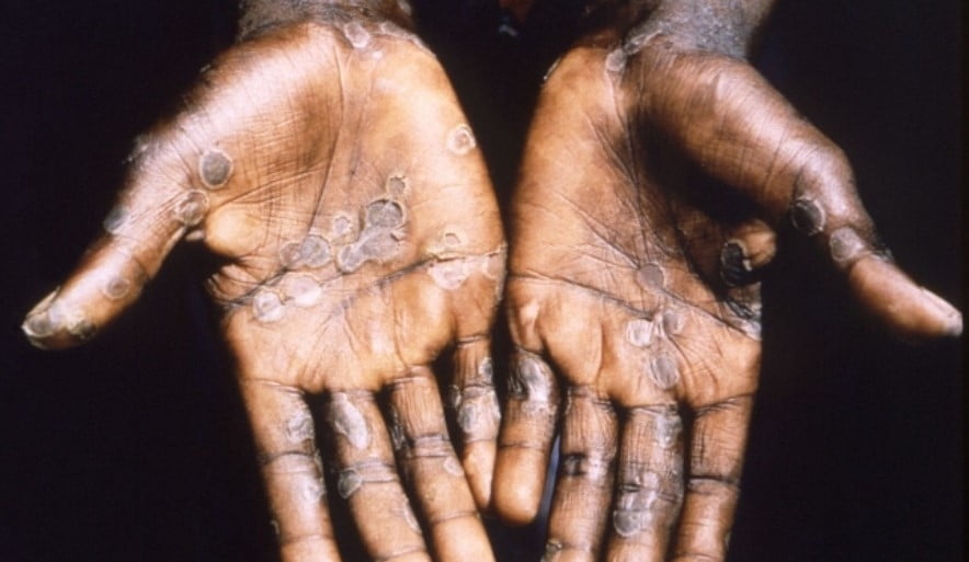 원숭이 두창에 감염된 손. 사진출처: 로이터