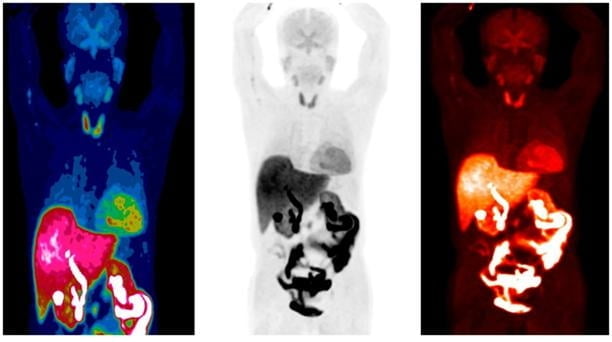 전신성 아밀로이드증을 진단 받은 환자의 아밀로이드 PET-CT 영상