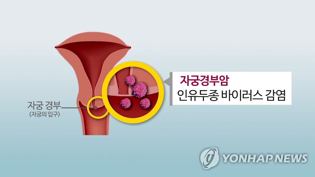 "자궁경부암, 백신으로 예방하는 유일한 암"…무료 접종 챙겨야