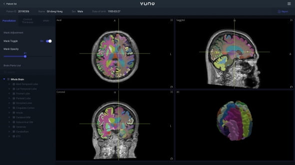 뷰노 “AI 의료기기 활용 뇌 MRI 검사, 심평원 급여 첫 인정”