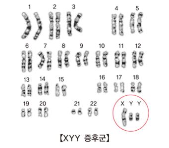 "성염색체 이상 남성, 당뇨병 등 일반 질병 위험↑"