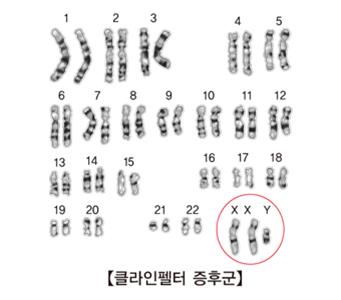 "성염색체 이상 남성, 당뇨병 등 일반 질병 위험↑"