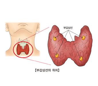 "부갑상선 기능항진증, 심근경색 위험↑"