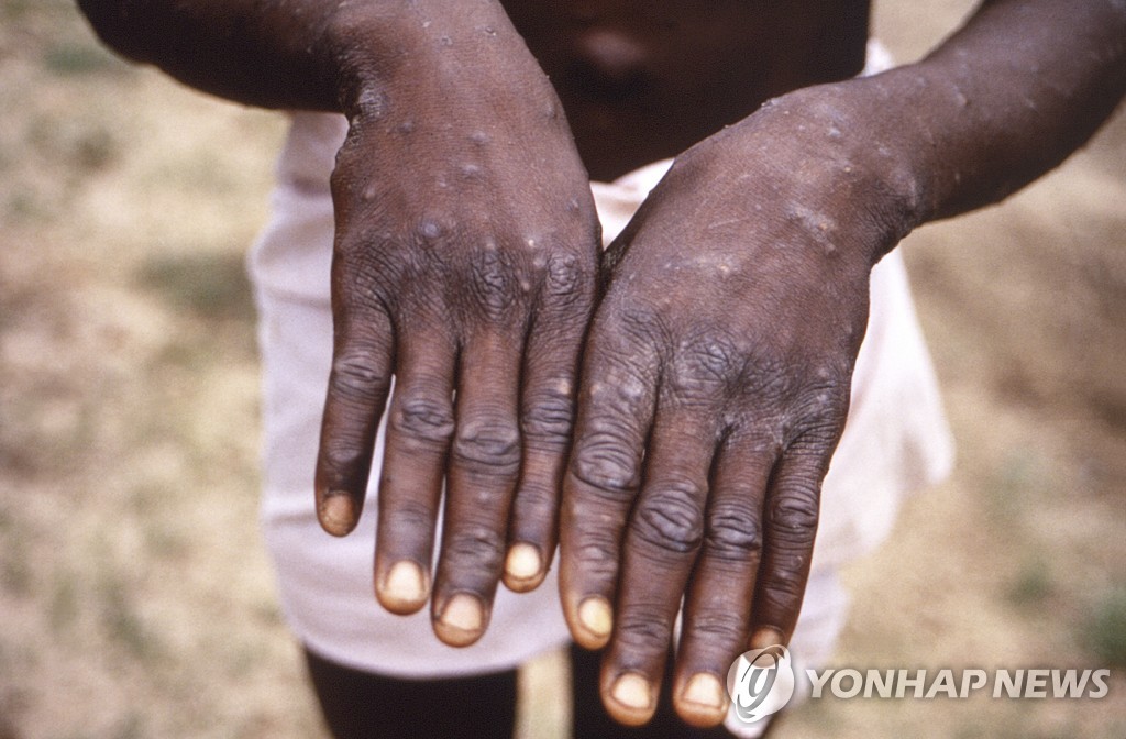 레바논서도 원숭이두창 감염 보고…해외여행 후 귀국자