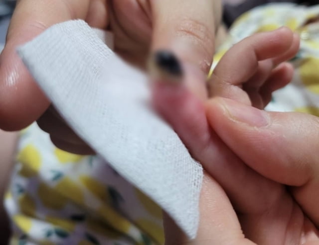 17개월 아기의 손가락이 유모차에 끼여 절단되는 사고가 발생했다. 봉합 수술을 받았지만, 피부가 괴사된 모습. / 사진=온라인 커뮤니티