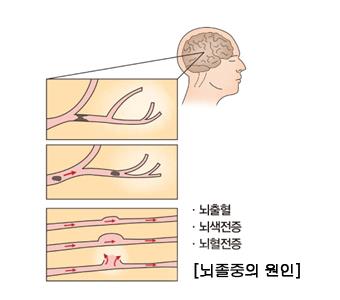 "불임·습관성 유산·사산, 뇌졸중 위험↑"