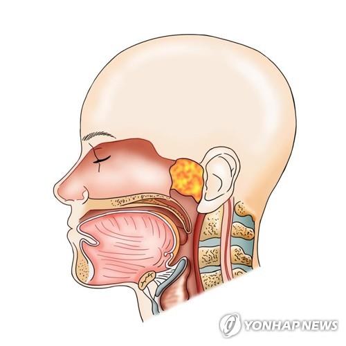 "국가건강검진 때 구강검진 꼭 받아야…두경부암 예방에 도움"