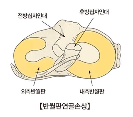 "반월판 연골 손상, 운동·물리요법으로 충분"