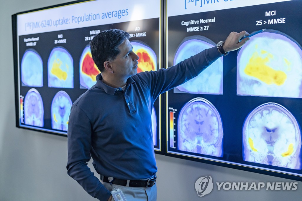 알츠하이머 핵심연구 자료 조작됐나…16년간 과학계 오도 의혹