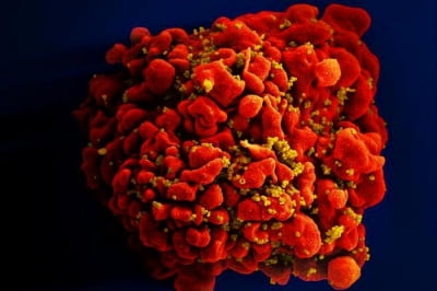 에이즈 바이러스, 감염 자체로 수명 5년 단축한다