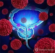 "전립선암 환자, 장 세균총이 다르다"