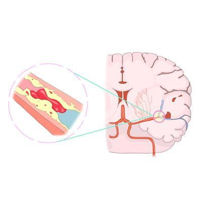 "뇌졸중 후 기억장애, 30%는 3개월 후 개선"