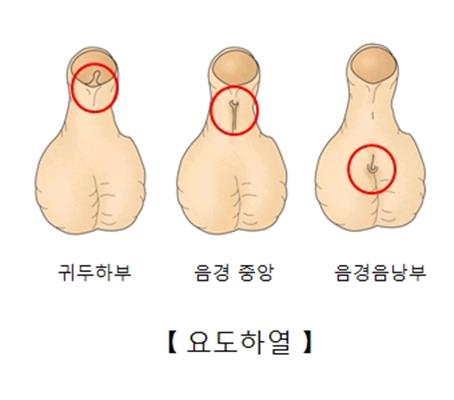 "요도하열, 선천성 심장 결손 동반할 수도"