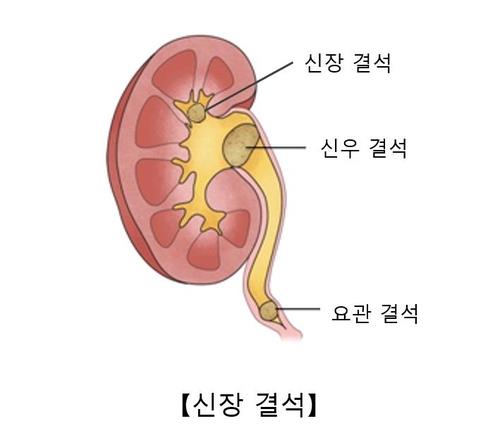 "고칼슘·고칼륨 식사, 신장 결석 재발 차단"