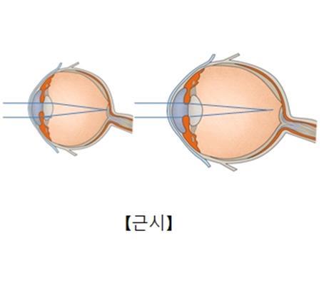 "카페인 대사산물 메틸잔틴, 근시 진행 억제"