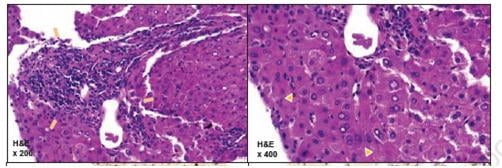 조직병리학적 소견에 따른 환자의 간 조직 이상 모습. 