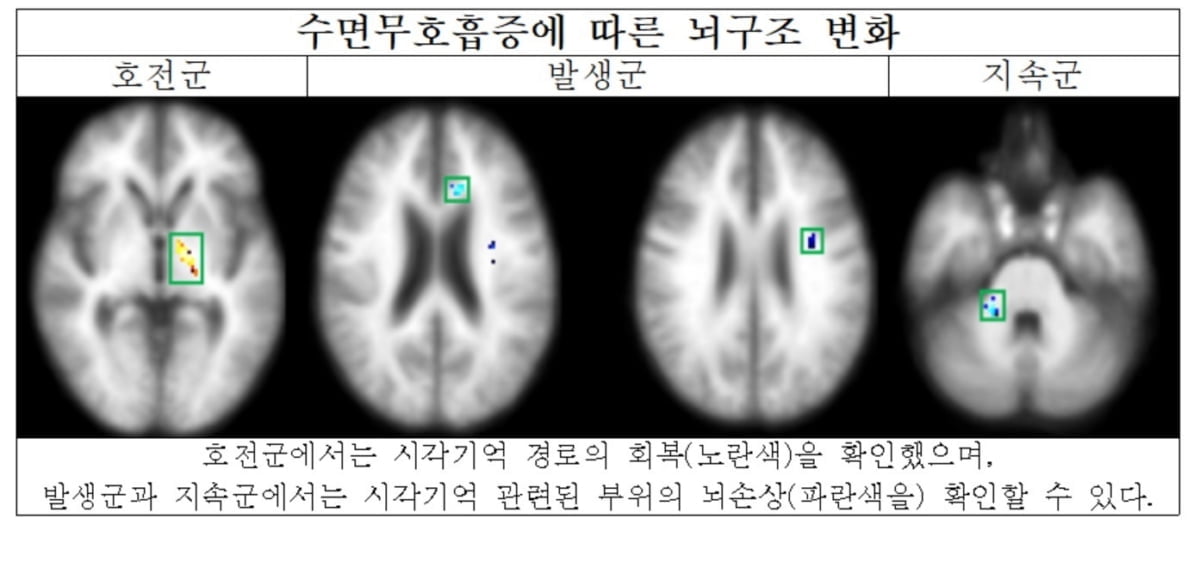 수면무호흡증 대규모 환자 연구…"뇌·인지기능 악영향"