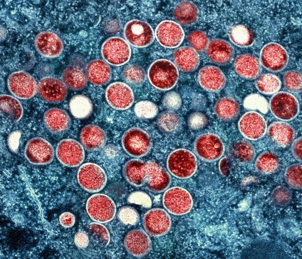 원숭이두창 바이러스 입자(붉은색) 전자현미경 이미지.(사진=AP=연합뉴스)