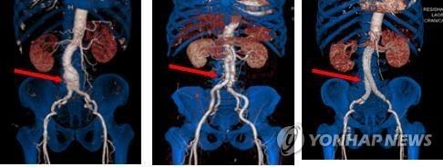 "복부 대동맥류, 암·치매·우울증 발병 위험도 높인다"