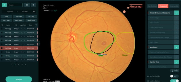 뷰노, 국제 의료AI 당뇨망막병증 분석 경진대회서 1위